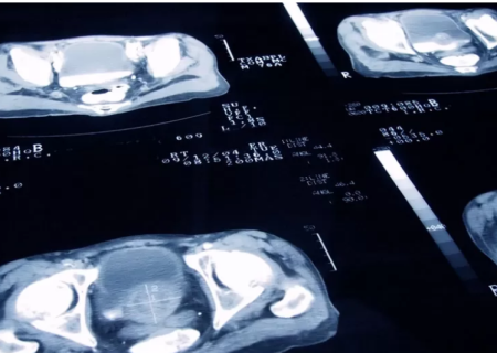 دوزهای رادیوتراپی در درمان سرطان پروستات