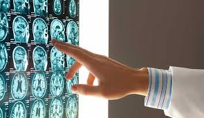 علائم سکته مغزی در زنان و مردان