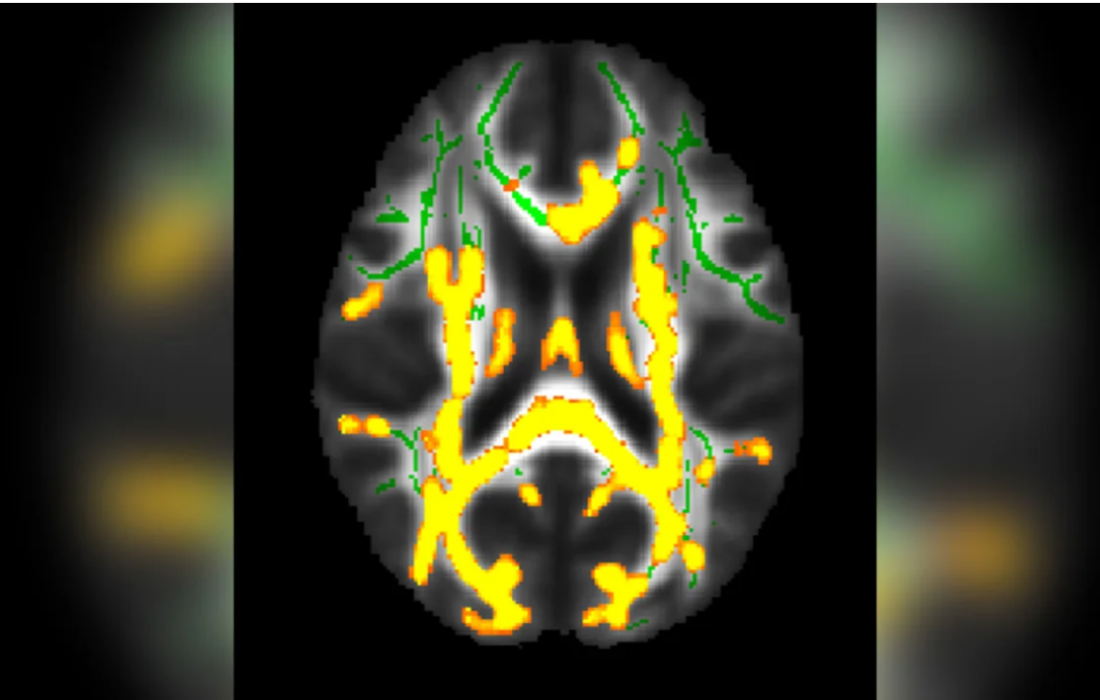 ارتباط چربی پنهان شکم با التهاب مغز و زوال عقل
