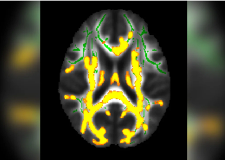 ارتباط چربی پنهان شکم با التهاب مغز و زوال عقل