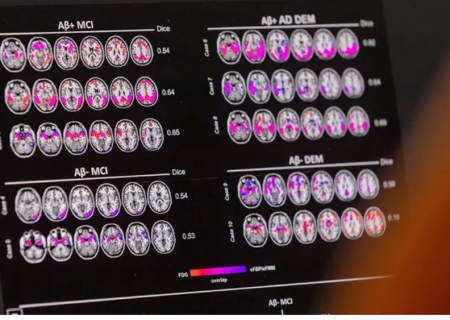 مطالعه محققان در باره تاثیر پروتئین ها در رابطه با زوال عقل