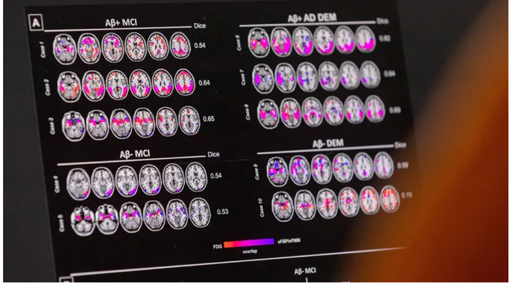 مطالعه محققان در باره تاثیر پروتئین ها در رابطه با زوال عقل